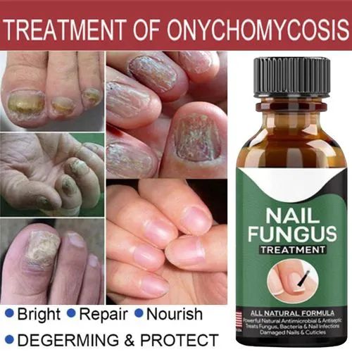 Nail Fungal Treatments Nail Repair Essences Serum, Foot Nail Fungus Removal Gel