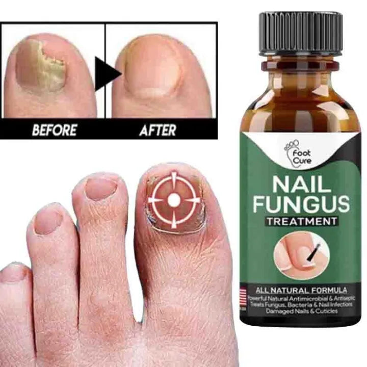 Nail Fungal Treatments Nail Repair Essences Serum, Foot Nail Fungus Removal Gel